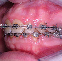 Ortodonzia tradizionale - Dott. Paolo Cumani - Dentista