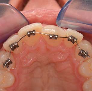 Ortodonzia tradizionale - Dott. Paolo Cumani - Dentista