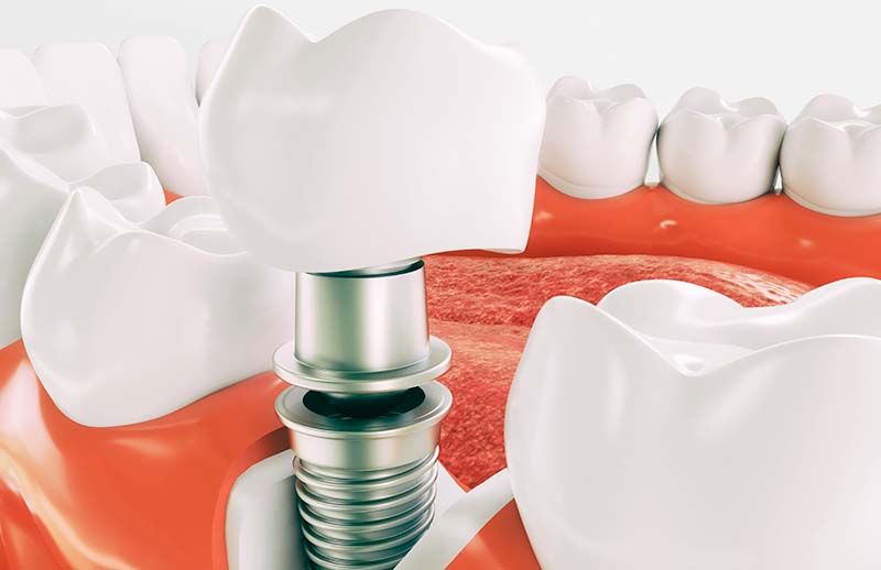 Implantologia semplice e complessa - Dott. Paolo Cumani - Dentista