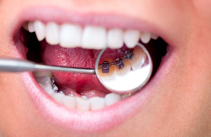 Ortodonzia linguale - Dott. Paolo Cumani - Dentista